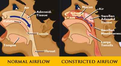 What Causes Snoring